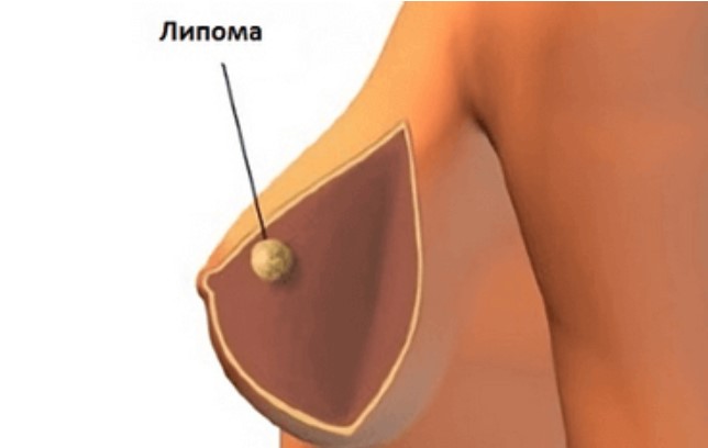 Липома, гигрома, атерома, фиброма кожи - лечение в Нижнем Тагиле — ОЛМЕД