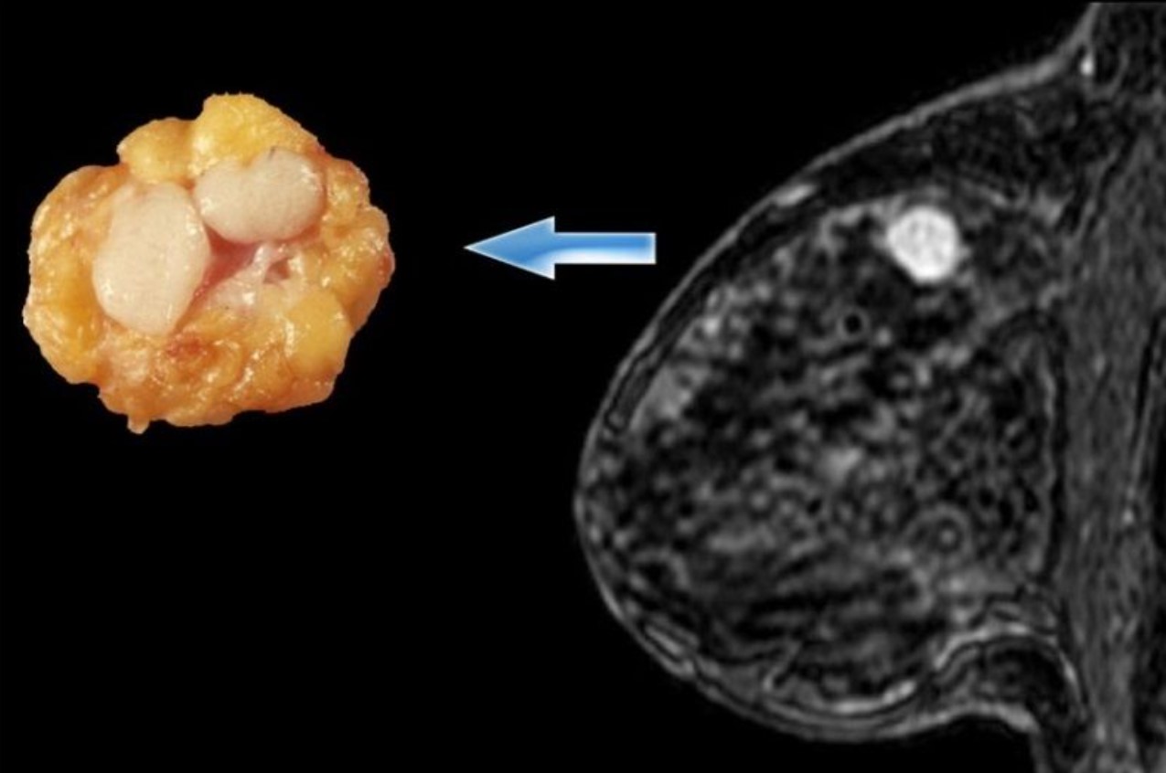 Очаговое образование фиброаденома молочной железы