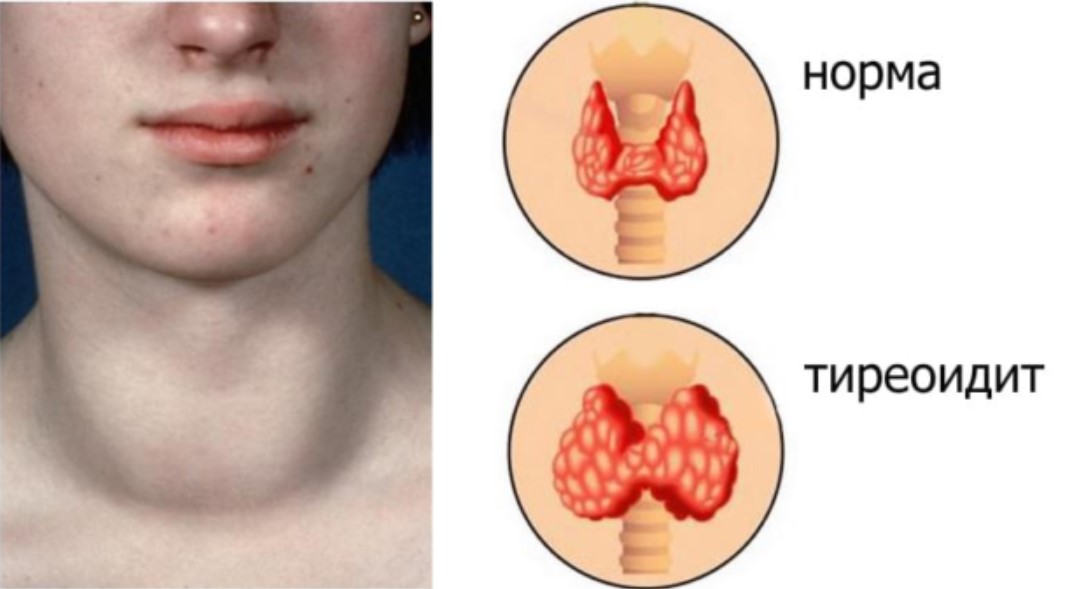 Щитовидная железа можно лечить. Хашимото щитовидной железы. Аутоиммунный тиреоидит. Аутоиммунный тиреоиди.